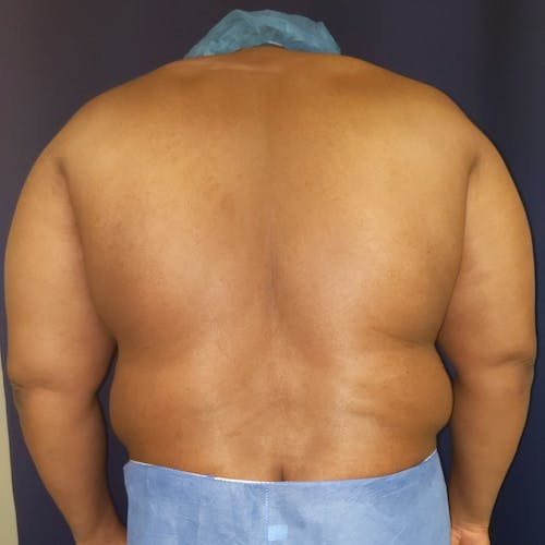 Male Liposuction Gallery - Patient 3821987 - Image 1