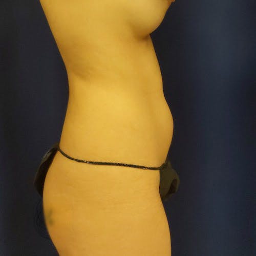 Abdominal Liposuction Gallery - Patient 4614863 - Image 5