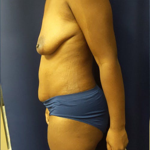 Tummy Tuck Gallery - Patient 4614917 - Image 4