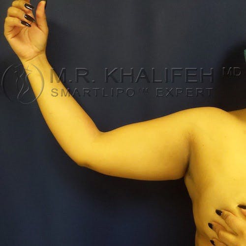 Arm Liposuction Gallery - Patient 4697899 - Image 1