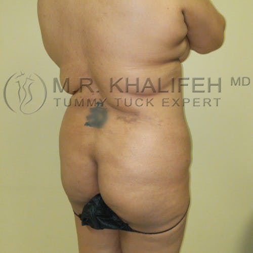 Brazilian Buttock Lift Gallery - Patient 5883442 - Image 3