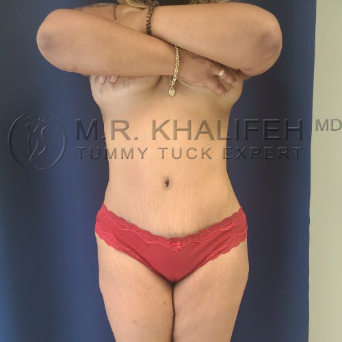 Flank-Lower Back Liposuction Gallery - Patient 5883463 - Image 12