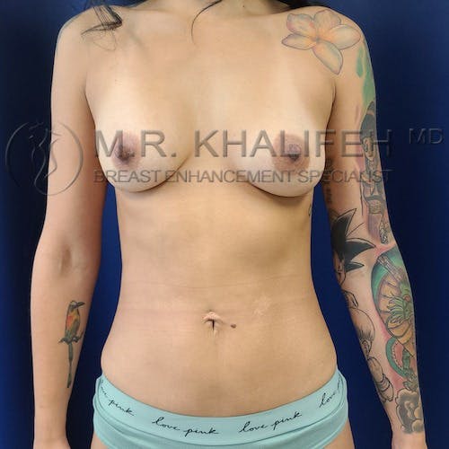 Fat Transfer Breast Augmentation Gallery - Patient 8669720 - Image 2