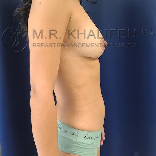 Fat Transfer Breast Augmentation Gallery - Patient 8669720 - Image 6