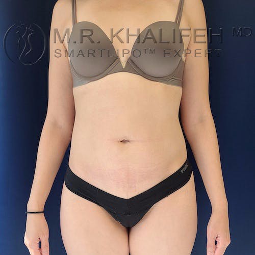 Flank-Lower Back Liposuction Gallery - Patient 10215476 - Image 4