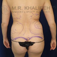 Flank-Lower Back Liposuction Gallery - Patient 10215476 - Image 1