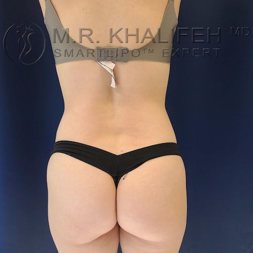 Flank-Lower Back Liposuction Gallery - Patient 10215476 - Image 2
