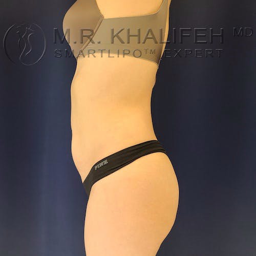 Flank-Lower Back Liposuction Gallery - Patient 10215476 - Image 8