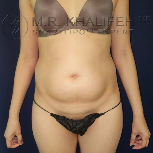 Abdominal Liposuction Gallery - Patient 10215514 - Image 1