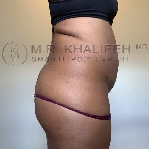 Flank-Lower Back Liposuction Gallery - Patient 11269968 - Image 3