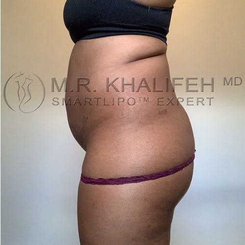Flank-Lower Back Liposuction Gallery - Patient 11269968 - Image 5