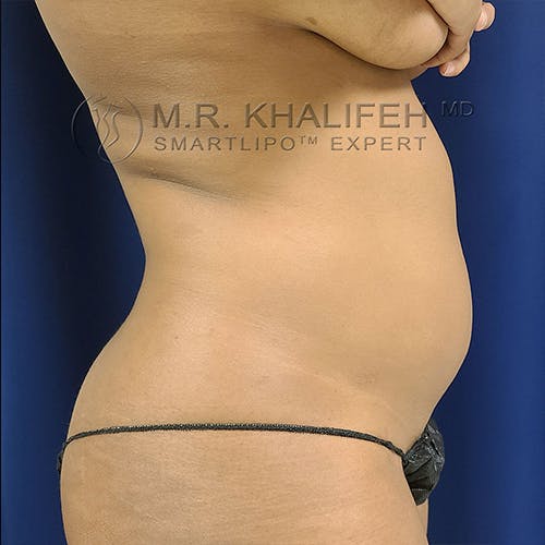 Abdominal Liposuction Gallery - Patient 13732372 - Image 3