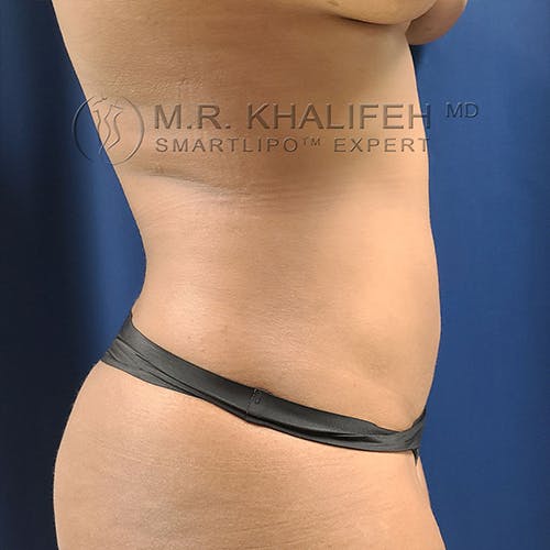 Abdominal Liposuction Gallery - Patient 13732372 - Image 4