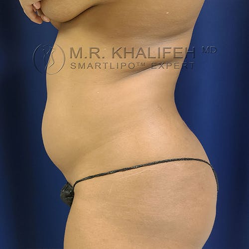 Abdominal Liposuction Gallery - Patient 13732372 - Image 5