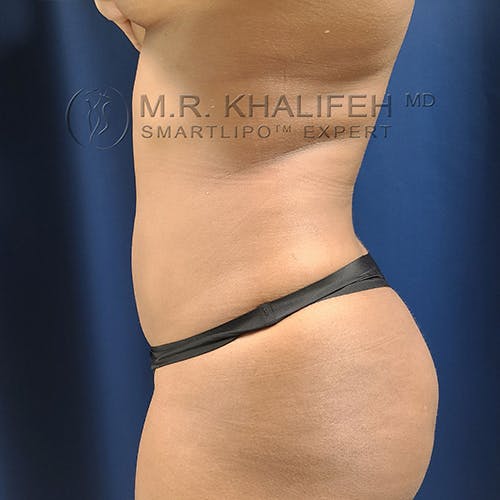 Abdominal Liposuction Gallery - Patient 13732372 - Image 6