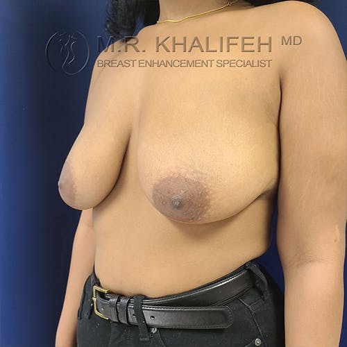 Breast Lift Gallery - Patient 13732556 - Image 3