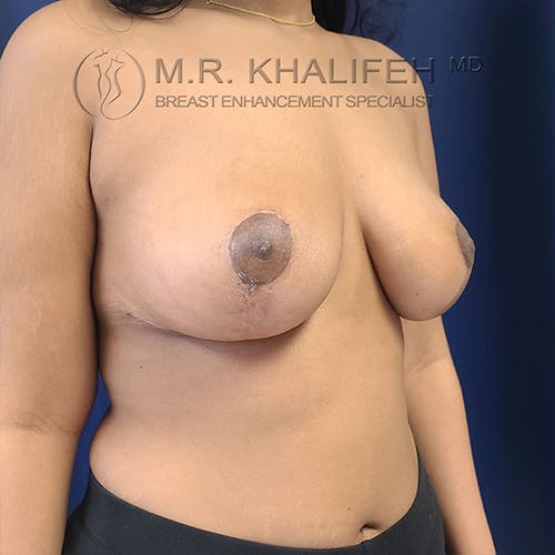 Breast Lift Gallery - Patient 13732556 - Image 8