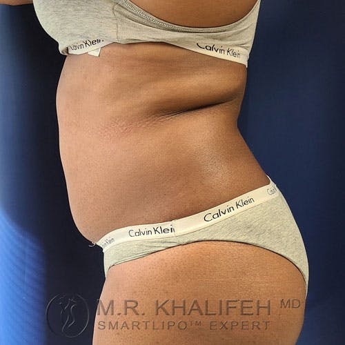 Flank-Lower Back Liposuction Gallery - Patient 14779359 - Image 3