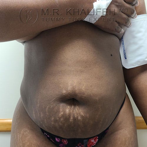 Tummy Tuck Gallery - Patient 17924365 - Image 1