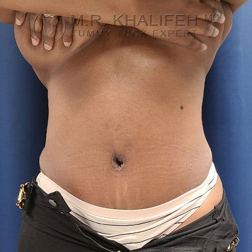 Tummy Tuck Gallery - Patient 17924365 - Image 2