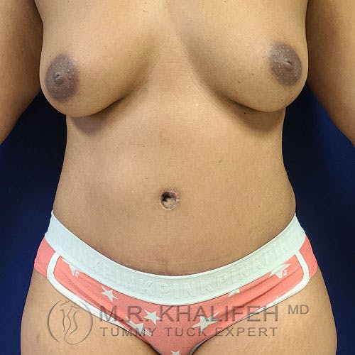 Tummy Tuck Gallery - Patient 17924366 - Image 2