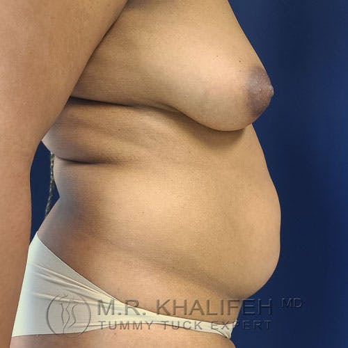 Tummy Tuck Gallery - Patient 17924366 - Image 3