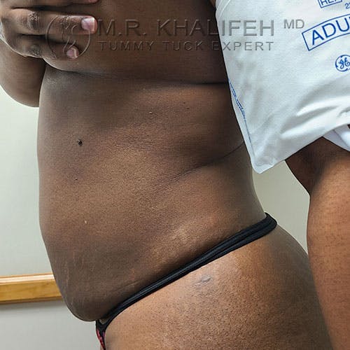 Tummy Tuck Gallery - Patient 17924365 - Image 5