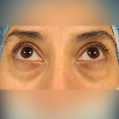 Eyelid Surgery  Gallery - Patient 18426909 - Image 1