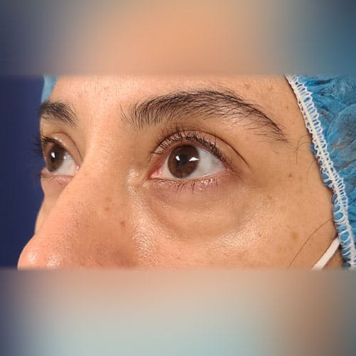 Eyelid Surgery  Gallery - Patient 18426909 - Image 5