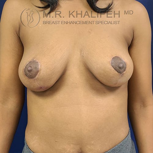 Breast Lift Gallery - Patient 18426911 - Image 10