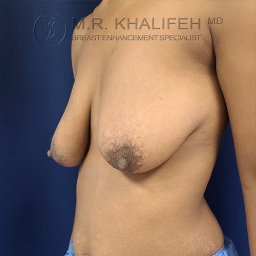 Breast Lift Gallery - Patient 18426911 - Image 3