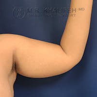 Arm Liposuction Gallery - Patient 21143636 - Image 1