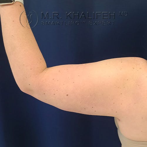 Arm Liposuction Gallery - Patient 22113626 - Image 8
