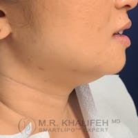 Chin and Neck Liposuction Gallery - Patient 24071374 - Image 1