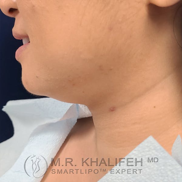 Chin and Neck Liposuction Gallery - Patient 24071374 - Image 3