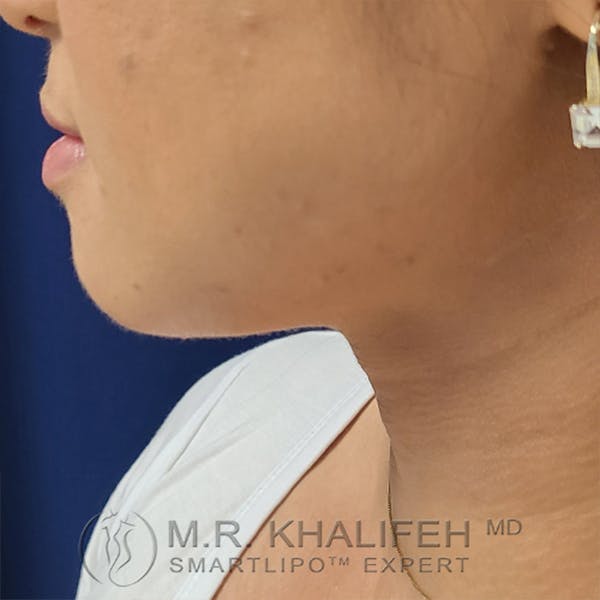 Chin and Neck Liposuction Gallery - Patient 24071374 - Image 4