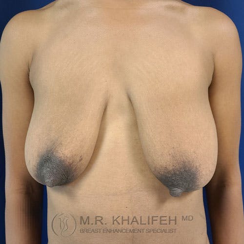 Breast Lift Gallery - Patient 24090619 - Image 1