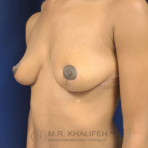 Breast Lift Gallery - Patient 24090619 - Image 4