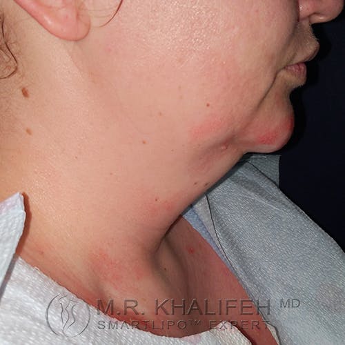 Chin and Neck Liposuction Gallery - Patient 24557980 - Image 1