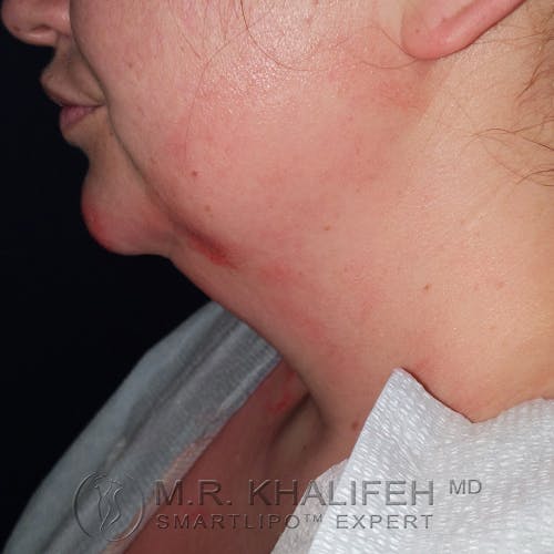 Chin and Neck Liposuction Gallery - Patient 24557980 - Image 3