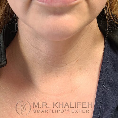 Chin and Neck Liposuction Gallery - Patient 24557980 - Image 6