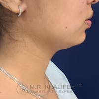 Chin and Neck Liposuction Gallery - Patient 25853396 - Image 1
