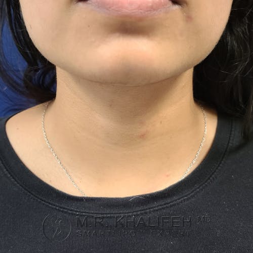 Chin and Neck Liposuction Gallery - Patient 25853396 - Image 6