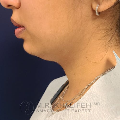 Chin and Neck Liposuction Gallery - Patient 25853396 - Image 3