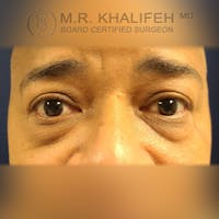 Eyelid Surgery  Gallery - Patient 39766043 - Image 1