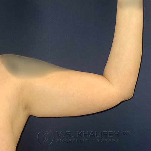 Arm Liposuction Gallery - Patient 39766079 - Image 3