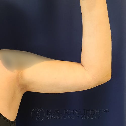 Arm Liposuction Gallery - Patient 39766079 - Image 4