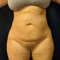 Tummy Tuck Gallery - Patient 39769207 - Image 1