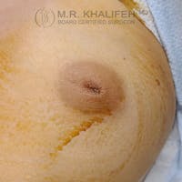 Inverted Nipple Correction Gallery - Patient 39769237 - Image 1