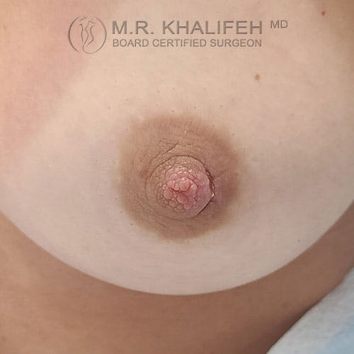 Inverted Nipple Correction Gallery - Patient 39769237 - Image 2